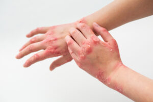 Natural Psoriasis Treatment in Madurai