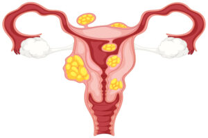 Ayurvedic Treatment for Polycystic Ovaries in Madurai