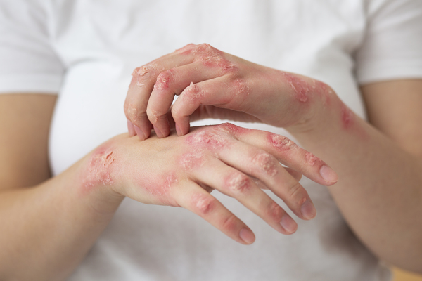 Ayurvedic Treatment for Psoriasis Madurai